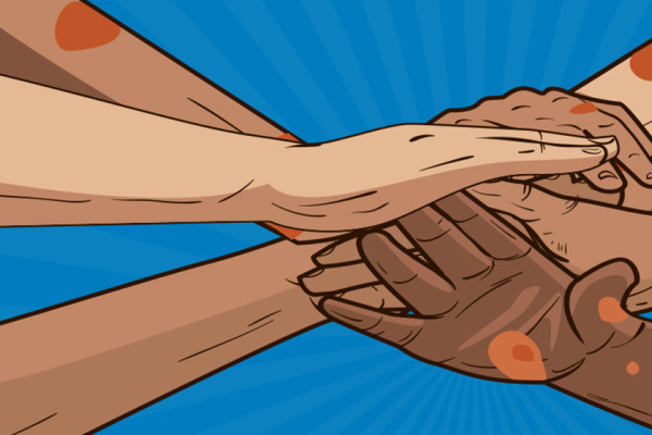 पर्वतमा कुष्ठरोगीको सङ्ख्या घट्दै, चारजना उपचाररत