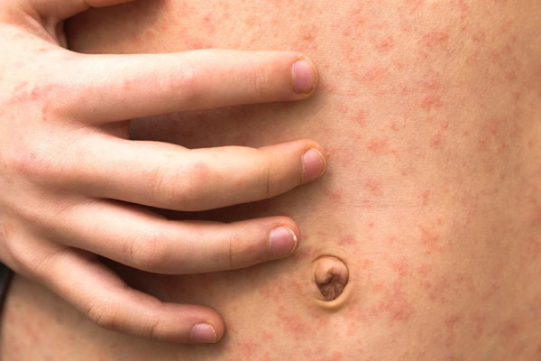 ढोरपाटनमा दादुरा फैलिने जोखिम : स्वास्थ्य सतर्कता अपनाउन आग्रह