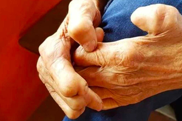 कुष्ठरोग नियन्त्रण गर्न बढ्दो चुनौती, मधेसका ४५ पालिका कुष्ठरोगमुक्त