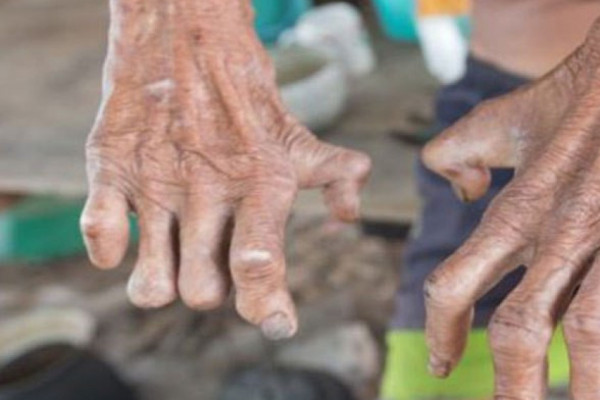 कुष्ठरोग प्रभावितमाथि अझै विभेद : कानुन पुनरावलोकन गर्न सुझाव